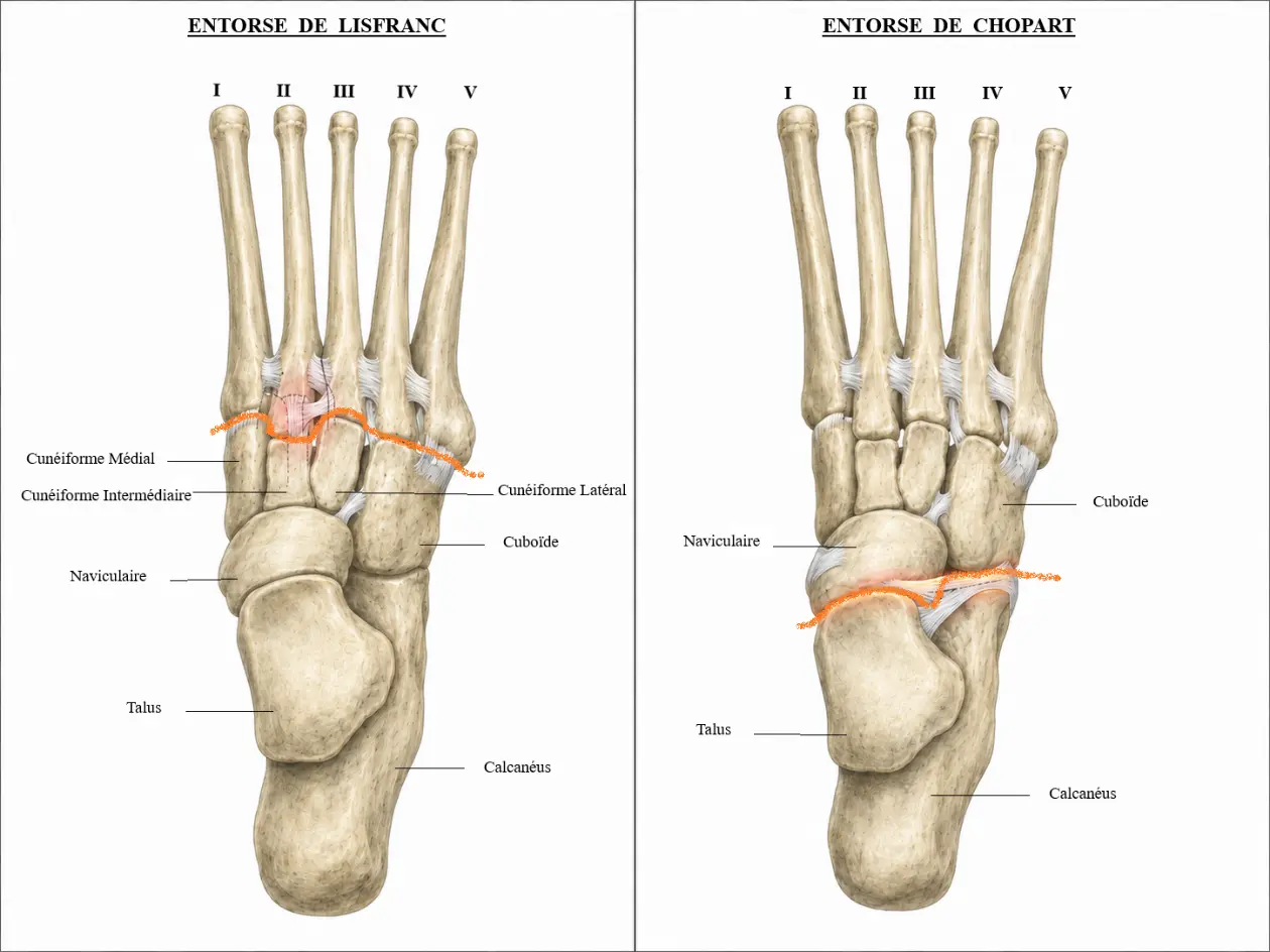 Illustration 1 — Entorse du médiopied : Chopart / Lisfranc