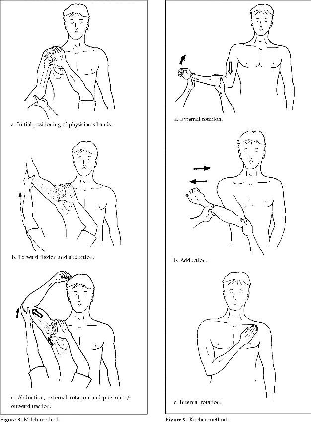 Illustration 2 — Luxation de l’articulation gléno-humérale